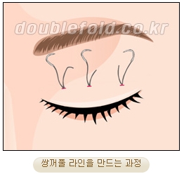 두한성형외과 쌍커풀재수술 - 삼중 쌍커풀 라인 교정 관련 이미지 13
