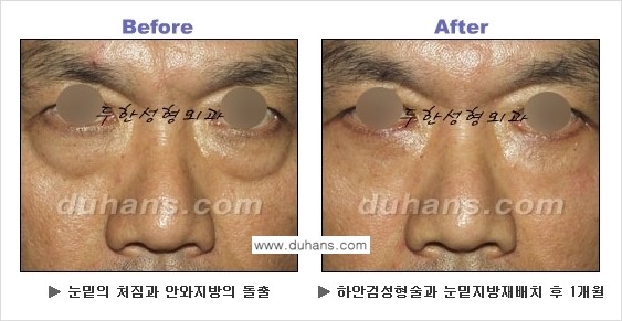 [두한성형외과의 상큼하고 환한 젊은 눈매완성] - [하안검 성형술 ①] 관련 이미지 20
