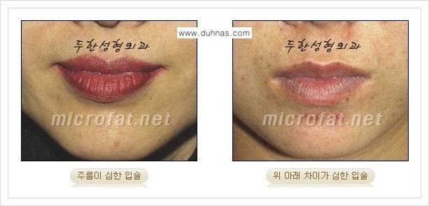 [두한성형외과 경쟁력 미세지방이식] - [입술 미세지방이식 안내 1.] 관련 이미지 3