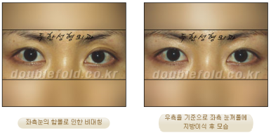 [Duhan Plastic Surgery Eye Surgery] - [Asymmetric Line, Eyelash Eversion, Deep Fixation] image 19