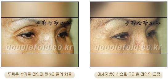 [두한성형외과 쌍커풀수술] - [눈성형 방법에 대한 자주하는 질문과 답변] 관련 이미지 95