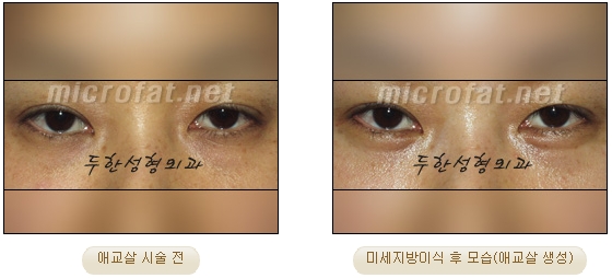 ​[두한성형외과 지방이식] - [애교살] 관련 이미지 22