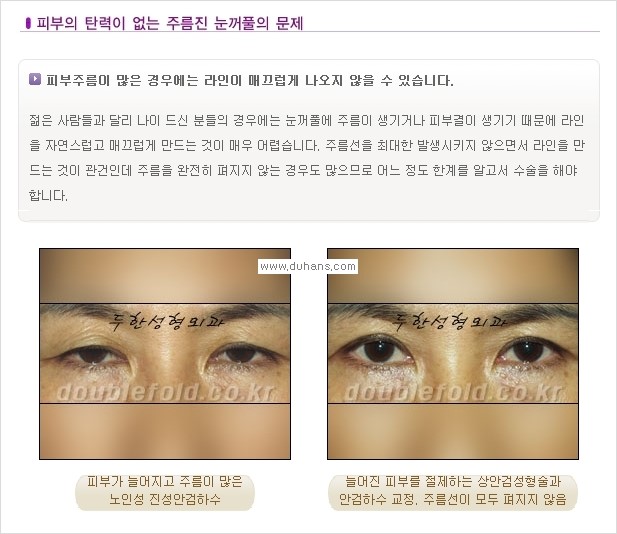 [두한성형외과 경쟁력 쌍꺼풀 재수술, 극한 재수술] - [쌍꺼풀 재수술, 극한 재수술 시 문제점 안내] 관련 이미지 7