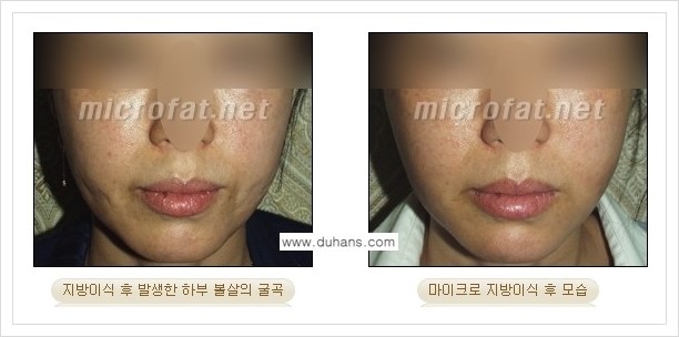 ​[두한성형외과 경쟁력 미세지방이식] - [타 병원에서 지방이식 후 발생한 굴곡현상 교정 방법 - 마이크로 지방이식] 관련 이미지 9