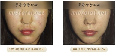 Facial Fat Liposuction at Duhan Plastic Surgery - Cheek Fat Liposuction, Jawline Liposuction, Under-Eye Fat Liposuction image 33