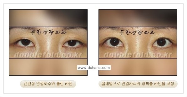 [두한성형외과 경쟁력 쌍꺼풀 재수술, 극한 눈 재수술] - [안검하수(졸리운 눈매) 재수술 안내] 관련 이미지 5