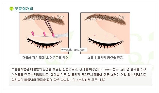 [두한성형외과 경쟁력 눈성형] - [퀵쌍꺼풀 - 부분절개법] 관련 이미지 2