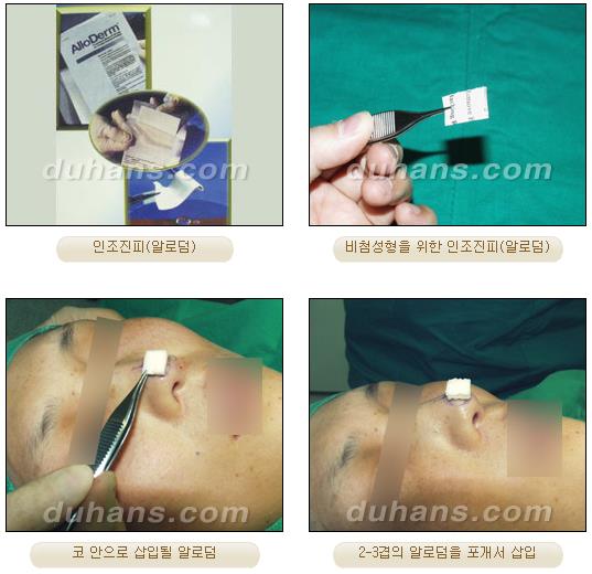 DuHan Plastic Surgery Revision Rhinoplasty - AlloDerm Nose Surgery, SureDerm Nose Surgery image 2
