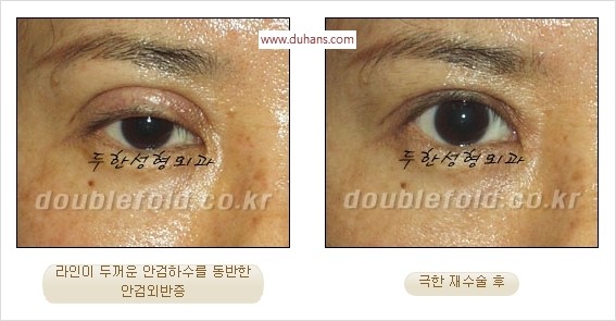 [두한성형외과 경쟁력 쌍꺼풀 재수술] - [두꺼운 라인을 교정하는 극한 재수술(Extreme Rroperation)] 관련 이미지 12
