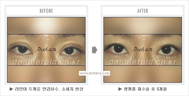 [두한성형외과 경쟁력 쌍꺼풀 재수술] - [절개선 아래가 두툼한 소세지 현상 + 눈매교정 안내] 관련 이미지 17