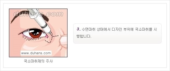 [두한성형외과 경쟁력 눈성형] - [앞트임 수술(몽고주름 제거) 안내 ②] 관련 이미지 3