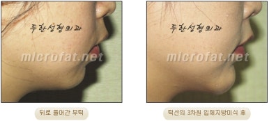 [Duhan Plastic Surgery Clinic Microgenia Correction] - [Chin Microfat Grafting] image 25