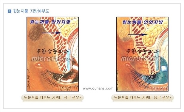[두한성형외과 경쟁력 지방제거] - [눈 지방제거 안내] 관련 이미지 2