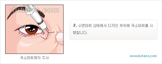 [두한성형외과 경쟁력 눈성형] - [몽고주름 제거수술, 앞트임 수술 안내] 관련 이미지 9