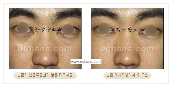 [두한성형외과 경쟁력 눈밑성형] - [꺼진 눈밑, 눈밑 함몰 주름선 눈밑 미세지방이식 안내] 관련 이미지 28