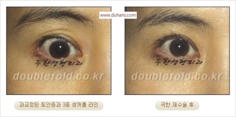 ​[두한성형외과 눈재수술] - [앞트임복원, 뒤트임복원, 쌍꺼풀복원] 관련 이미지 33