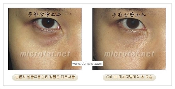 [두한성형외과 경쟁력 눈밑성형] - [눈밑 다크써클과 눈밑 함몰주름의 최적화 교정방법 안내] 관련 이미지 25