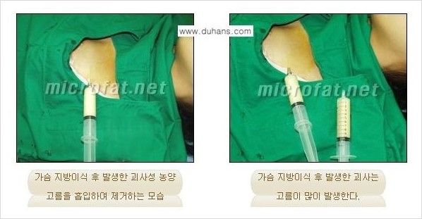 ​[두한성형외과 경쟁력 지방이식] - [지방이식 부작용 이후 마이크로 지방흡입, 마이크로 지방흡입 이후 부작용 없는 지방이식 방법] 관련 이미지 4