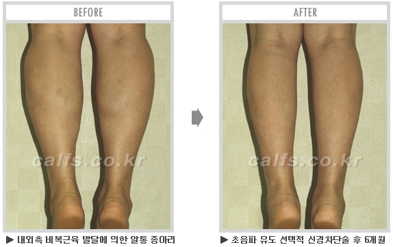[종아리성형 두한성형외과] - [종아리수술에 대한 자주하는 질문과 답변 모음] 관련 이미지 72