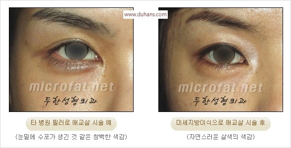[두한성형외과 경쟁력 눈밑성형] - [타 병원 필러 애교살 시술 부작용을 미세지방이식으로 교정] 관련 이미지 1