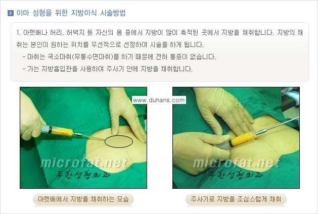 [두한성형외과의 경쟁력 미세지방이식] - [이마 미세지방이식 안내 ①] 관련 이미지 6