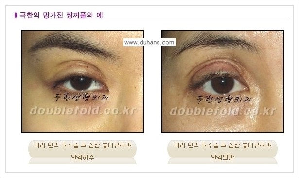 [두한성형외과 경쟁력 쌍꺼풀 재수술] - [극한의 상태에서 쌍꺼풀 재수술 안내 ①] 관련 이미지 1