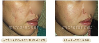 [두한성형외과 지방이식] - [지방이식 부작용 종류와 문제점] 관련 이미지 24