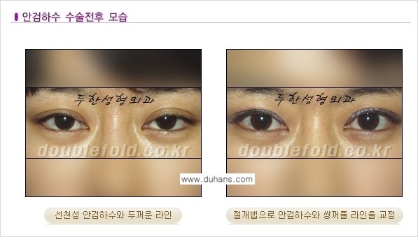 [두한성형외과 NO.1 "극한 눈(쌍꺼풀 재수술)"] - [안검하수(졸린눈매) 재수술 안내 3.] 관련 이미지 2