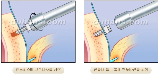두한성형외과 안티에이징 리프팅 - 엔도타인 리프팅 관련 이미지 41