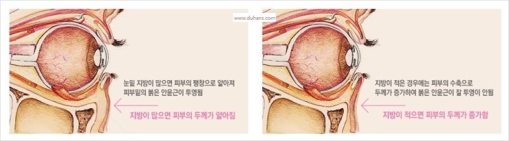 [두한성형외과 경쟁력 눈밑성형] - [눈밑 다크써클 맞춤 치료 방법] 관련 이미지 5