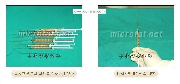 ​[두한성형외과 경쟁력 지방이식] - [지방이식 부작용 이후 마이크로 지방흡입, 마이크로 지방흡입 이후 부작용 없는 지방이식 방법] 관련 이미지 15