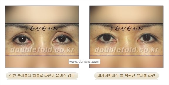 [두한성형외과 경쟁력 눈성형] - [미세지방이식으로 풀린 라인의 교정 방법 안내] 관련 이미지 4