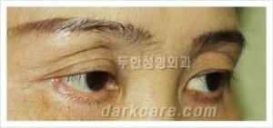 [두한성형외과 경쟁력 눈밑성형] - [다크써클 수술 동시 콤비 프로그램 안내] 관련 이미지 2