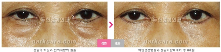 [두한성형외과 다크서클] - [다크서클 전후사진 검증] 관련 이미지 130