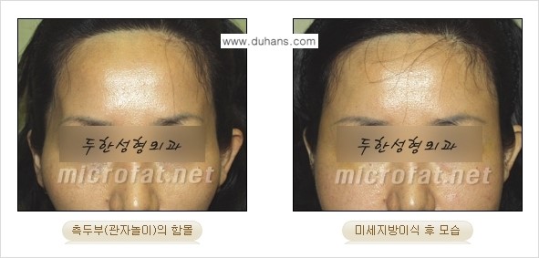 [두한성형외과 경쟁력 미세지방이식] - [관자놀이(측두부) 지방이식] 관련 이미지 7