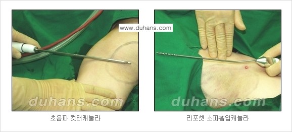 [두한성형외과 성형 FOCUS 지방흡입] - [액취증 - 다한증 초음파 컷터 지방흡입 ③] 관련 이미지 3
