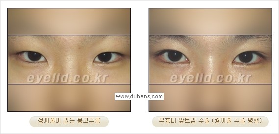 [두한성형외과 경쟁력 눈성형] - [안검하수와 몽고주름에 대한 자주하는 질문과 답변] 관련 이미지 16