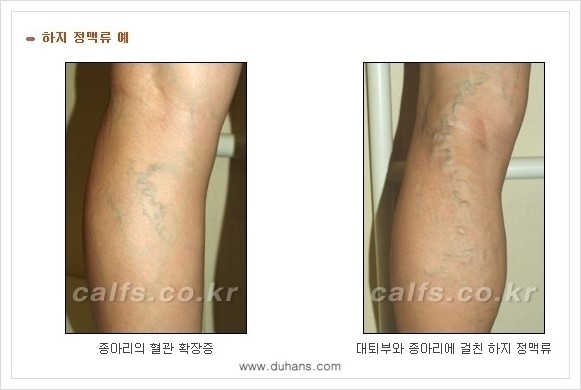 [두한성형외과 경쟁력 멀티종아리성형] - [나에게 맞는 종아리성형 방법의 종류 안내 3.] 관련 이미지 5