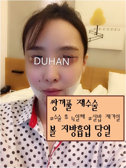 [두한성형외과] - [쌍꺼풀재수술, 눈재수술, 쌍꺼풀라인낮추기, 볼지방흡입, V라인] 관련 이미지 4
