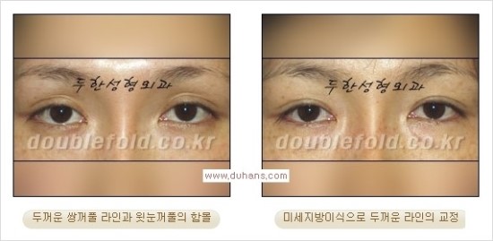 [두한성형외과 경쟁력 눈성형] - [쌍꺼풀 재수술 과정과 쌍꺼풀 재수술 실패의 원인, 쌍꺼풀 재수술의 성공 요건] 관련 이미지 36