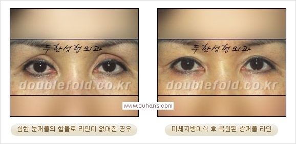 [두한성형외과 경쟁력 쌍꺼풀 재수술, 극한 눈재수술] - [미세지방이식으로 쌍꺼풀 라인의 복원에 관한 질문과 답변] 관련 이미지 5