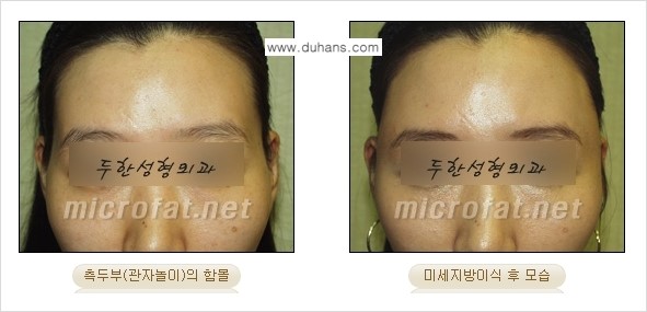 [두한성형외과 경쟁력 미세지방이식] - [관자놀이(측두부) 지방이식] 관련 이미지 8