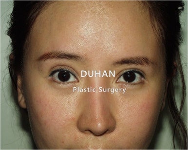 [Duhan Plastic Surgery Double Eyelid Revision] - [Reducing the Double Eyelid Line] image 47