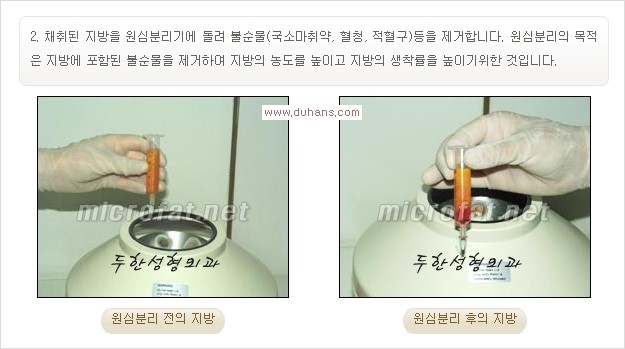 [두한성형외과 경쟁력 주름성형] - [입가와 팔자의 주름제거 지방이식 1.] 관련 이미지 4