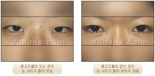 쌍커풀수술 두한성형외과 - 나에게 맞는 눈성형은? 관련 이미지 47