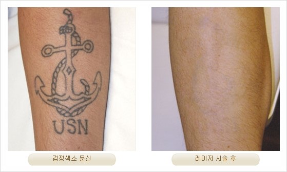 [두한성형외과 경쟁력 안전성형] - [최첨단 장비를 이용한 흉터, 점, 주근깨, 잡티, 문신제거 레이저 시술] 관련 이미지 32