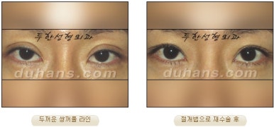 Best Place for Revision Eyelid Surgery, Duhan Plastic Surgery - Lowering Double Eyelid Line image 38
