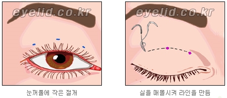 [두한성형외과 눈성형] - [쌍커풀수술] 관련 이미지 6
