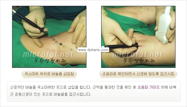 [두한성형외과 경쟁력 멀티종아리성형] - [초음파 유도 비절개 선택적 신경차단술의 효과] 관련 이미지 12