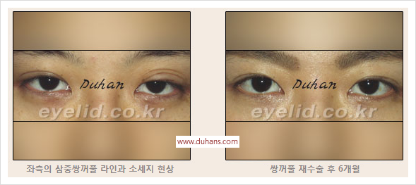 [두한성형외과 경쟁력 눈성형] - [절개법, 매몰법의 수술 방법] 관련 이미지 14
